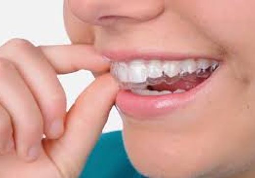 Niềng răng invisalign và 5 ưu điểm vượt trội