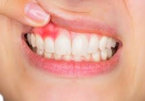 Điều trị viêm nướu: Giải pháp điều trị hiệu quả cho sức khỏe răng miệng