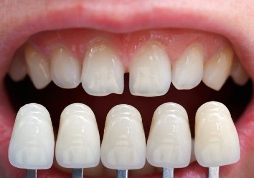 Những hậu quả bọc răng sứ bạn cần chú ý trước khi thực  hiện 
