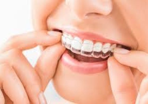 Niềng răng mắc cài trong suốt là gì? Ưu và nhược điểm