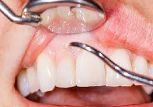 Viêm nha chu là gì? Cách chữa trị viêm nha chu hiệu quả