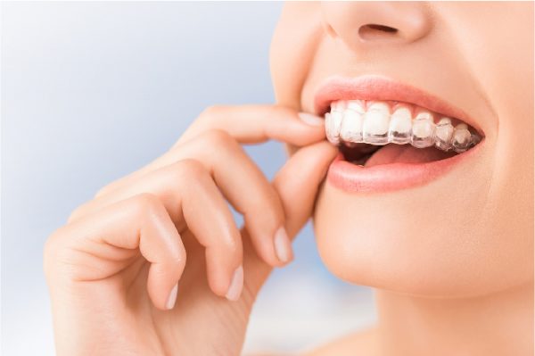 u-điểm-đột-phá-của-niềng-răng-trong-suốt-Invisalign-02-e1568349196985